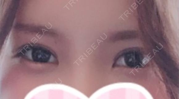 二重切開 / 上まぶたの脂肪取り id（アイディ）美容外科 DAY 55 メイン用