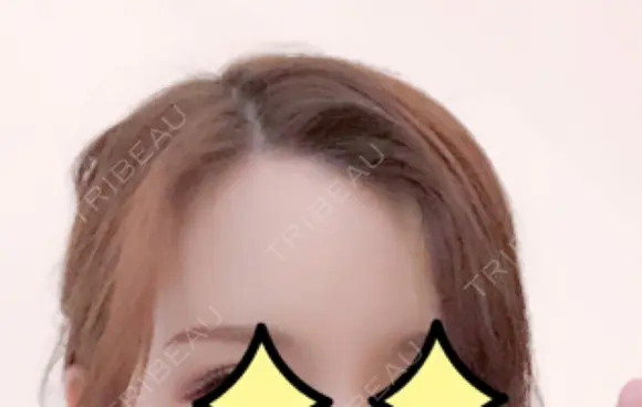 額を丸く / 脂肪注入（額） id（アイディ）美容外科 DAY 55 メイン用
