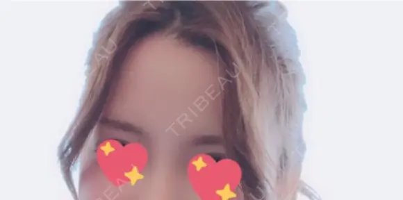 額を丸く / 脂肪注入（額） id（アイディ）美容外科 DAY 55 メイン用