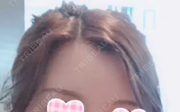 額を丸く / 脂肪注入（額） id（アイディ）美容外科 DAY 55 メイン用