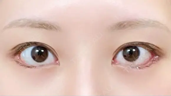 目尻切開 / タレ目形成・グラマラスライン（切開） / 目尻靭帯移動 eクリニック 金沢本院 DAY 25 メイン用