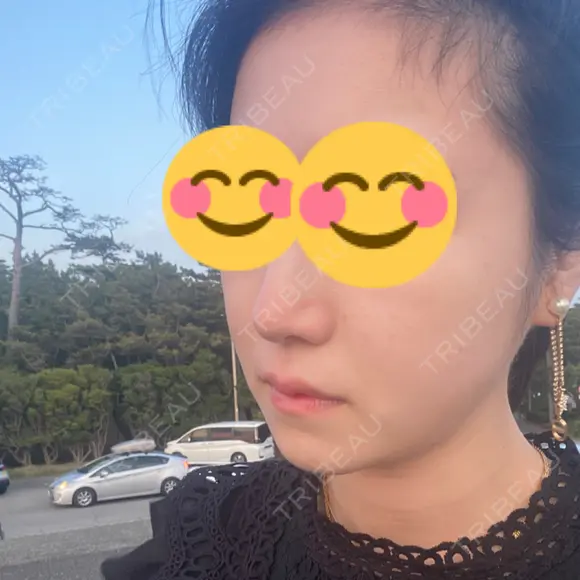 ピーリング（ニキビ・毛穴） 渋谷美容外科クリニック 新橋院 DAY 11 メイン用