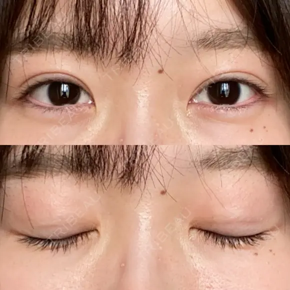 二重埋没 / 自然癒着法 シンデレラ＆ダヴィンチクリニック DAY 377 メイン用