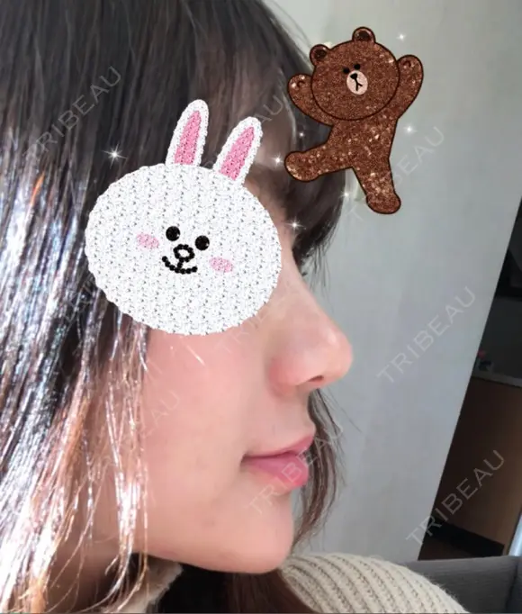 隆鼻術 / 鼻尖形成（切開） / 鼻中隔延長（切開） / 軟骨移植 グロービー美容整形外科 AFTER メイン用