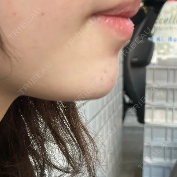 ボトックス（あご） / ヒアルロン酸注入（あご） フィラークリニック 大阪心斎橋院 DAY 0 メイン用