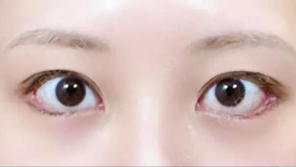 目尻切開 / タレ目形成・グラマラスライン（切開） / 目尻靭帯移動 eクリニック 金沢本院 DAY 26 メイン用