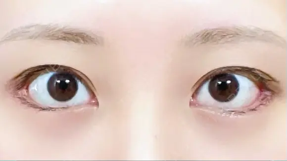 目尻切開 / タレ目形成・グラマラスライン（切開） / 目尻靭帯移動 eクリニック 金沢本院 DAY 27 メイン用