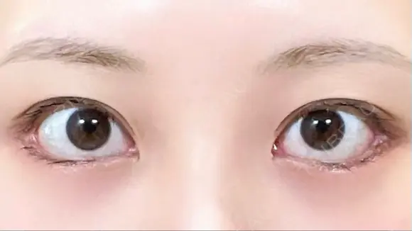 目尻切開 / タレ目形成・グラマラスライン（切開） / 目尻靭帯移動 eクリニック 金沢本院 DAY 28 メイン用