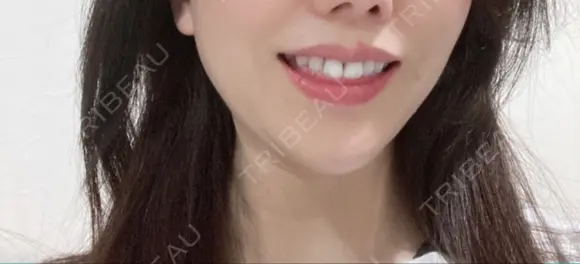 ヒアルロン酸注入（あご） / ボトックス（ガミースマイル） ルラ美容クリニック 新宿院 AFTER メイン用