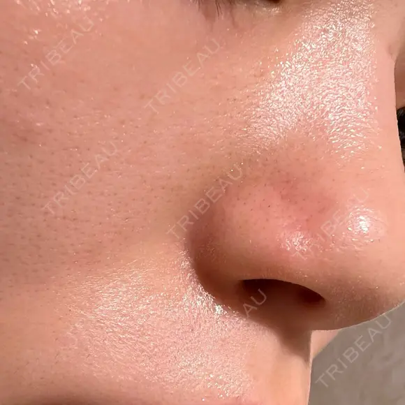 エレクトロポレーション / 毛穴洗浄（ハイドラフェイシャルなど） Fellez Clinic【フェルズクリニック】 AFTER メイン用