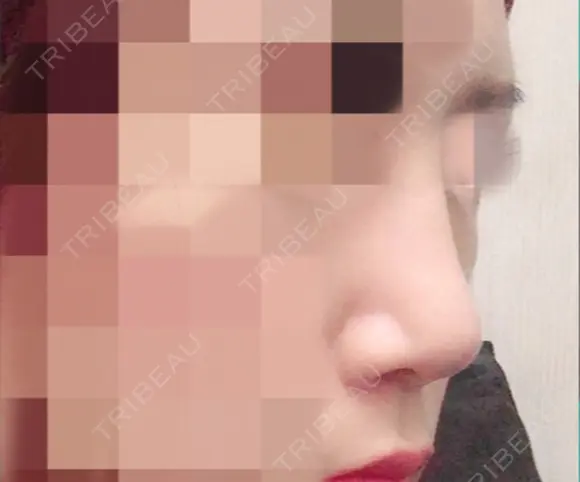隆鼻術 / 鼻尖形成（切開） / 眉間プロテーゼ サラ美容外科 DAY 12 メイン用
