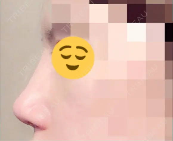 隆鼻術 / 鼻尖形成（切開） / 眉間プロテーゼ サラ美容外科 DAY 12 メイン用