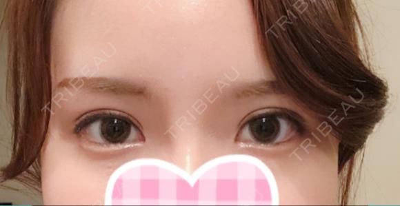 二重切開 / 上まぶたの脂肪取り id（アイディ）美容外科 AFTER メイン用