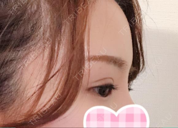 二重切開 / 上まぶたの脂肪取り id（アイディ）美容外科 DAY 70 メイン用