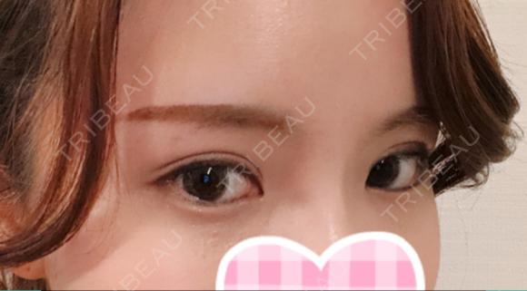 二重切開 / 上まぶたの脂肪取り id（アイディ）美容外科 DAY 70 メイン用