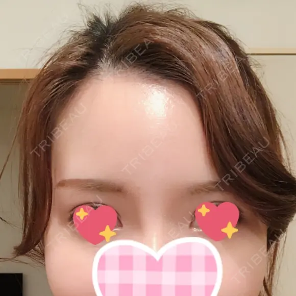 額を丸く / 脂肪注入（額） id（アイディ）美容外科 AFTER メイン用