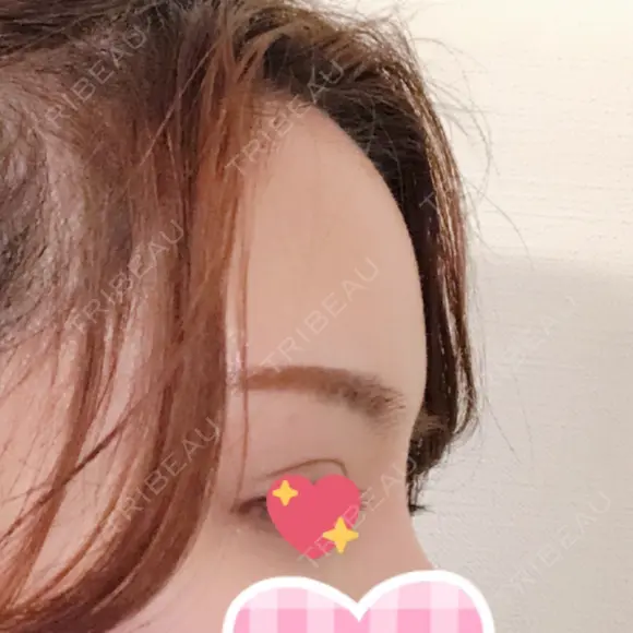 額を丸く / 脂肪注入（額） id（アイディ）美容外科 DAY 70 メイン用