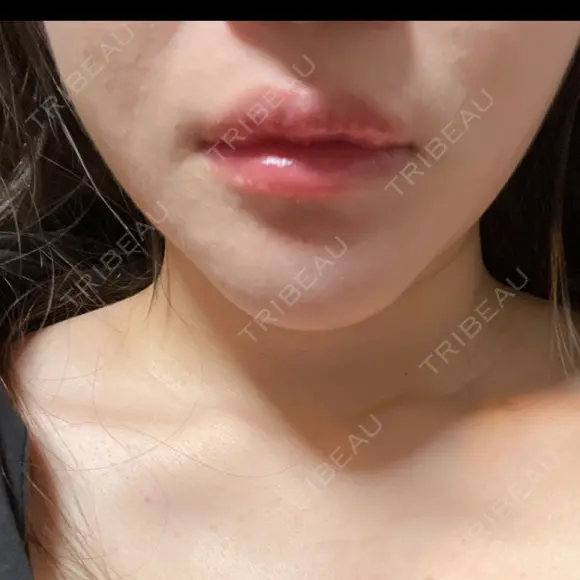 骨切り（あご） 銀座マイアミ美容外科 DAY 28 メイン用