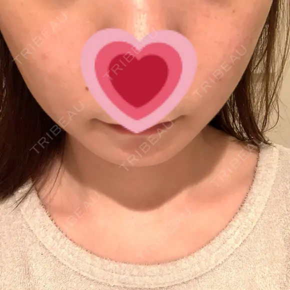 イオン導入 / フォトRF 湘南美容クリニック 表参道院 AFTER メイン用