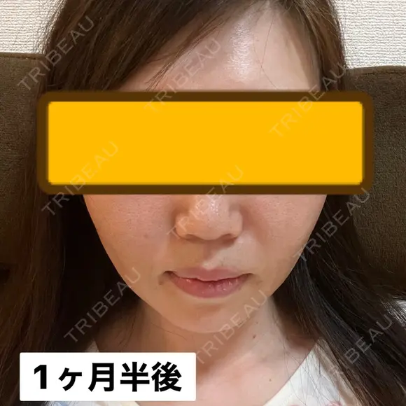 糸リフト / ヒアルロン酸注入（頬） EMMA CLINIC（エマクリニック） AFTER メイン用