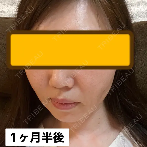 糸リフト / ヒアルロン酸注入（頬） EMMA CLINIC（エマクリニック） DAY 45 メイン用