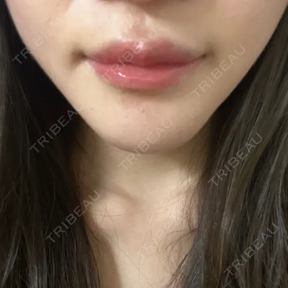 骨切り（あご） 銀座マイアミ美容外科 DAY 31 メイン用