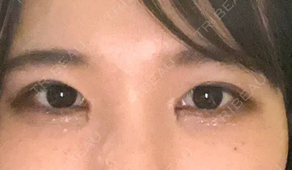 目頭切開 eクリニック 金沢本院 DAY 11 メイン用