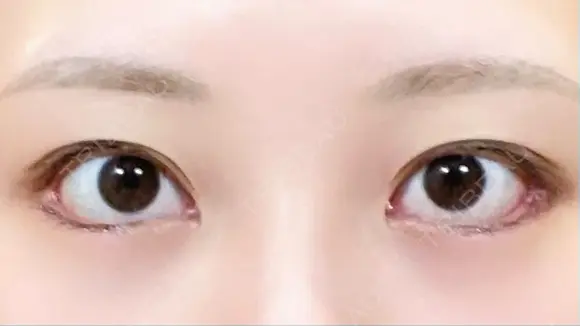 目尻切開 / タレ目形成・グラマラスライン（切開） / 目尻靭帯移動 eクリニック 金沢本院 DAY 30 メイン用