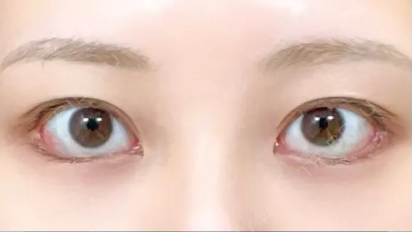 目尻切開 / タレ目形成・グラマラスライン（切開） / 目尻靭帯移動 eクリニック 金沢本院 DAY 31 メイン用