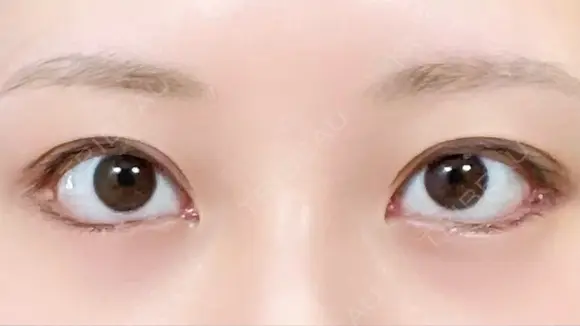 目尻切開 / タレ目形成・グラマラスライン（切開） / 目尻靭帯移動 eクリニック 金沢本院 DAY 32 メイン用