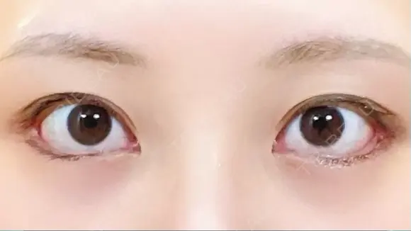 目尻切開 / タレ目形成・グラマラスライン（切開） / 目尻靭帯移動 eクリニック 金沢本院 DAY 33 メイン用