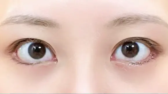 目尻切開 / タレ目形成・グラマラスライン（切開） / 目尻靭帯移動 eクリニック 金沢本院 AFTER メイン用