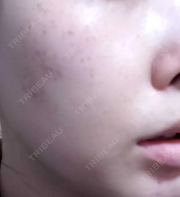 ピーリング（ニキビ・毛穴） / エレクトロポレーション / 光治療（フォトフェイシャルなど） AURORA CLINIC（オーロラクリニック）新宿院 DAY 2 メイン用