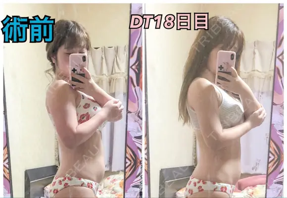 脂肪吸引（二の腕） ドクターフィット（Dr.fit）クリニック DAY 17 メイン用