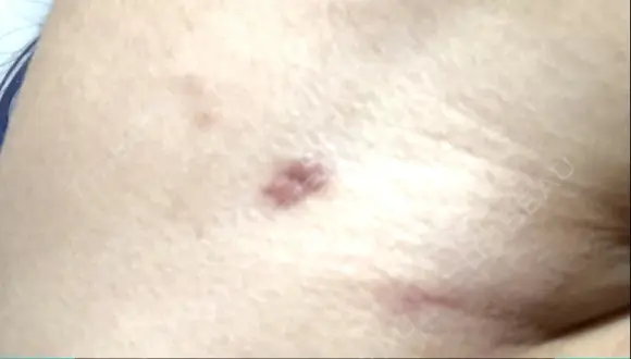 脂肪吸引（二の腕） ドクターフィット（Dr.fit）クリニック DAY 17 メイン用