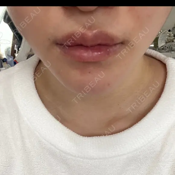 骨切り（あご） 銀座マイアミ美容外科 DAY 34 メイン用