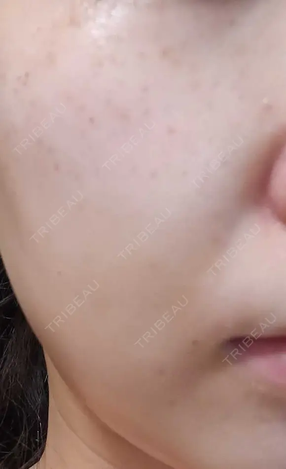 ピーリング（ニキビ・毛穴） / エレクトロポレーション / 光治療（フォトフェイシャルなど） AURORA CLINIC（オーロラクリニック）新宿院 DAY 4 メイン用