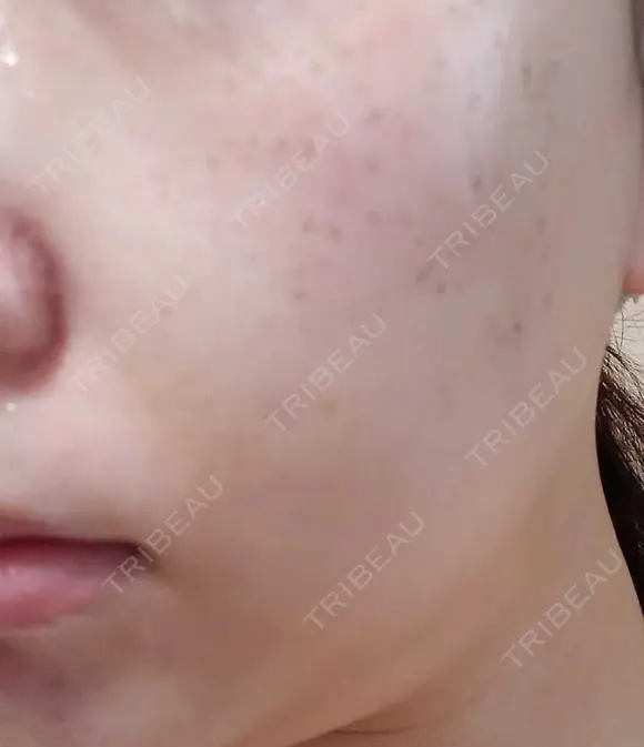 ピーリング（ニキビ・毛穴） / エレクトロポレーション / 光治療（フォトフェイシャルなど） AURORA CLINIC（オーロラクリニック）新宿院 AFTER メイン用