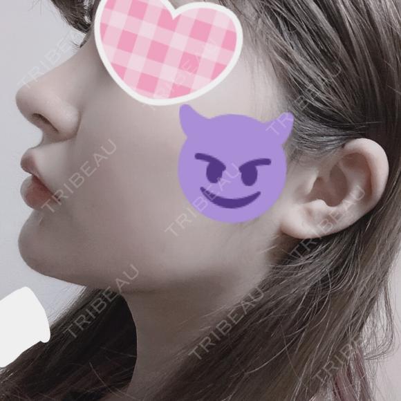 バッカルファット除去 / 脂肪吸引（顔） / ボトックス（あご） / ヒアルロン酸注入（あご） / ボトックス（エラ・小顔） / ヒアルロン酸注入（唇） / ボトックス（口角） エートップ美容整形外科 DAY 41 メイン用