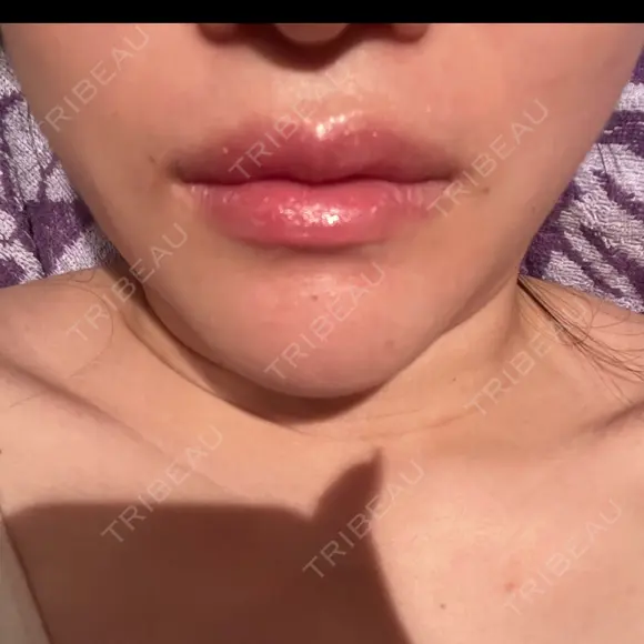 骨切り（あご） 銀座マイアミ美容外科 DAY 38 メイン用