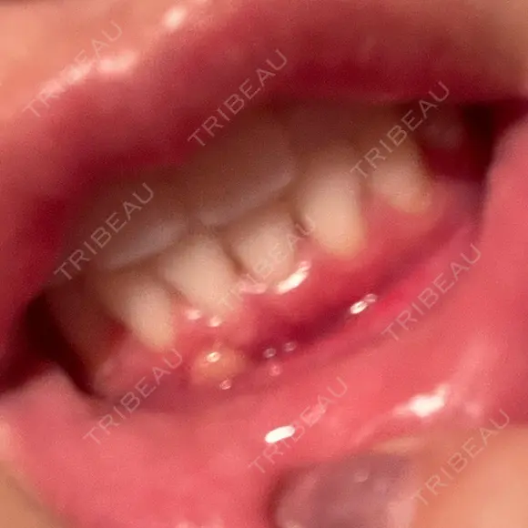 骨切り（あご） 銀座マイアミ美容外科 DAY 38 メイン用