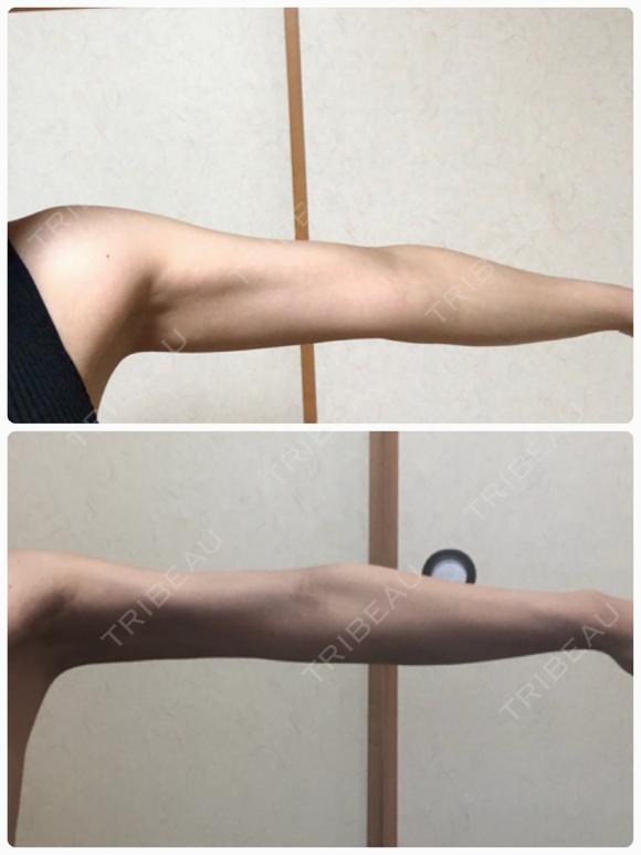 脂肪吸引（二の腕） ヨンセスリムライン DAY 45 メイン用