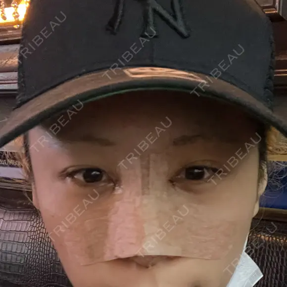 目頭切開 / 隆鼻術 / 鼻尖形成（切開） / 軟骨移植 湘南美容クリニック 金山院 DAY 0 メイン用