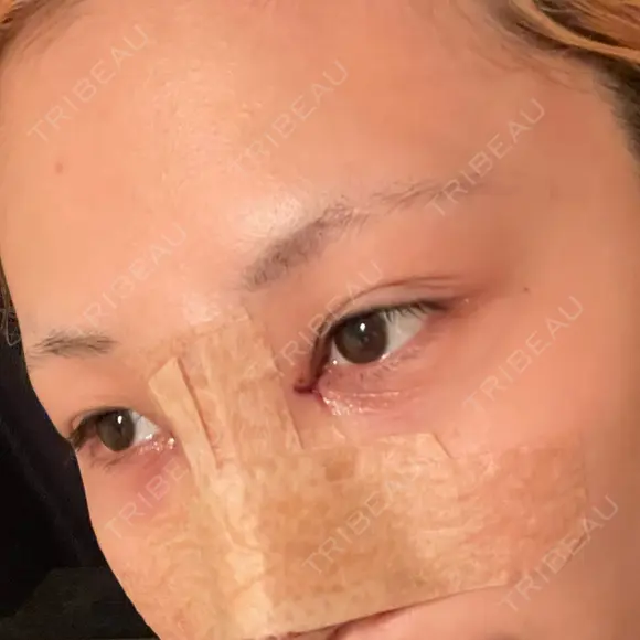 目頭切開 / 隆鼻術 / 鼻尖形成（切開） / 軟骨移植 湘南美容クリニック 金山院 DAY 0 メイン用