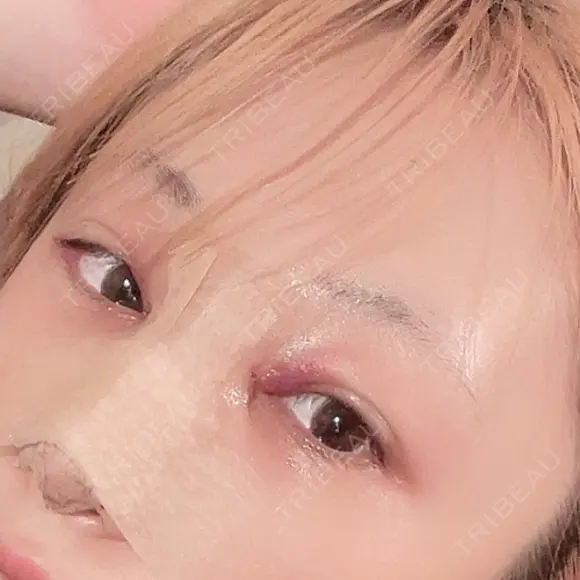 目頭切開 / 隆鼻術 / 鼻尖形成（切開） / 軟骨移植 湘南美容クリニック 金山院 DAY 1 メイン用