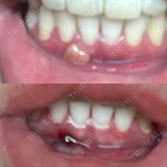 骨切り（あご） 銀座マイアミ美容外科 DAY 41 メイン用