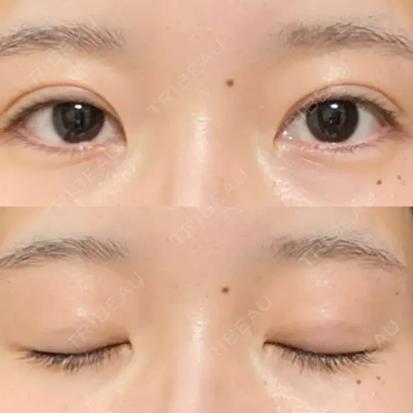 二重埋没 / 自然癒着法 シンデレラ＆ダヴィンチクリニック DAY 393 メイン用