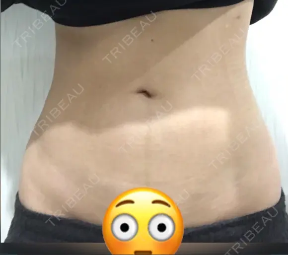 脂肪吸引（お腹） ドクターフィット（Dr.fit）クリニック DAY 42 メイン用