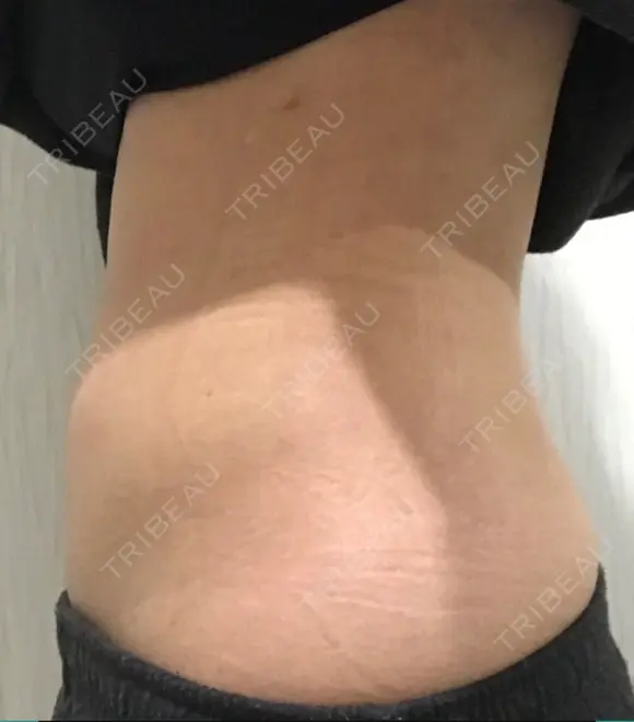 脂肪吸引（お腹） ドクターフィット（Dr.fit）クリニック DAY 42 メイン用