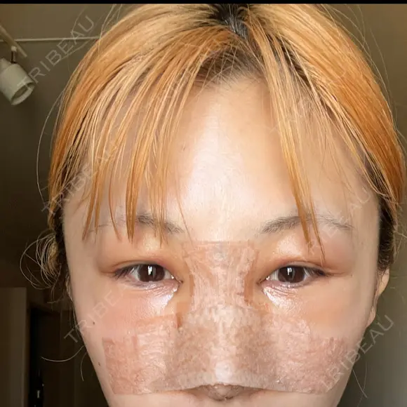 目頭切開 / 隆鼻術 / 鼻尖形成（切開） / 軟骨移植 湘南美容クリニック 金山院 AFTER メイン用